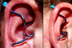 Helix-to-daith-trondustrial