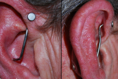 Inner-conch-to-forward-helix-trondustrial