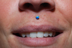 Dark-Blue-Philtrum-Healed