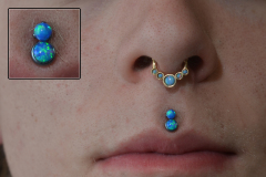 Double-Philtrum-Healed