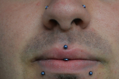 Vertical-Philtrum-blue