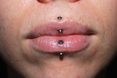 Vertical-lip-and-vertical-Philtrum