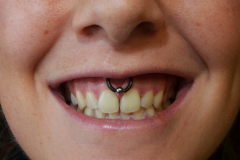 12g-Smiley-Healed