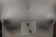 Flat-surface-sternum-healed