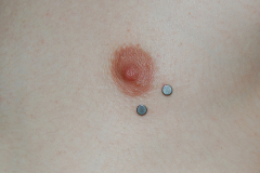 Nipple-anchors-healed