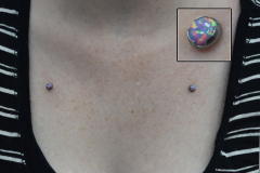 Opal-clavical-anchors-healed