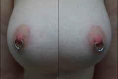 Dual-14g-nipple-cbrs-healed