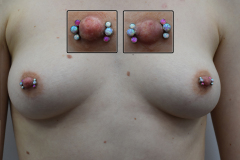 Pink-and-White-12g-Nipple-Clusters-Healed