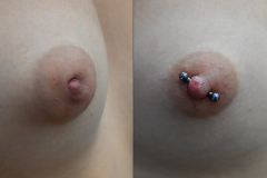 12g-Partially-Inverted-Nipple