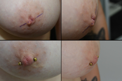 Inverted-nipple-fix_healing